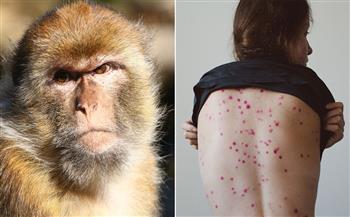   ارتفاع الإصابات بجدري القرود في المملكة المتحدة إلى  حالة